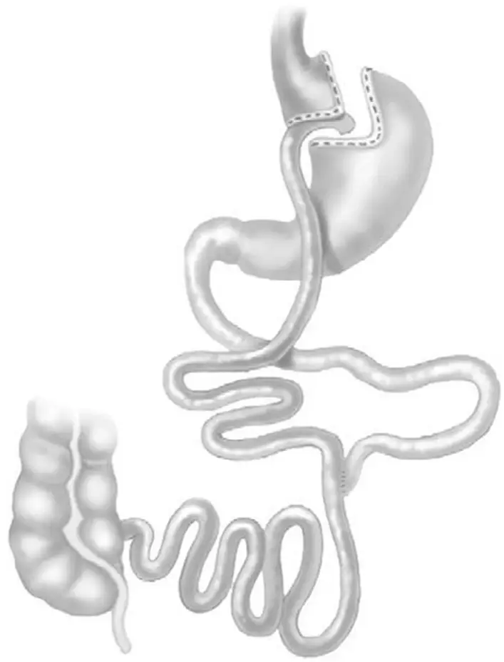 Ch17-Fig2-roux-en-Y-gastric-bypass Ch17-Fig2-roux-en-Y-gastric-bypass