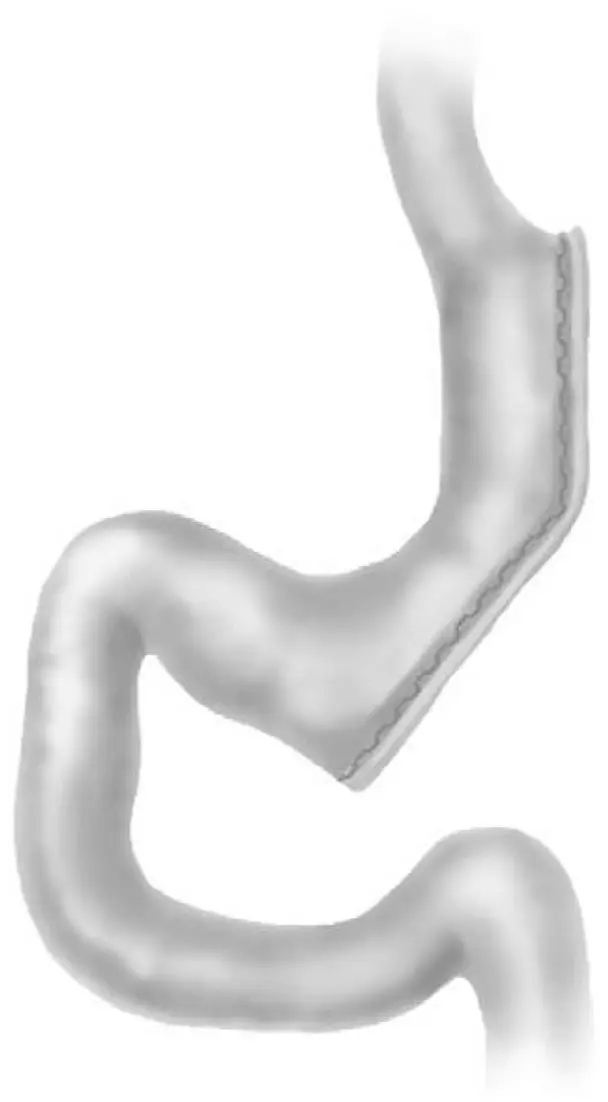 Ch17-Fig1-gastric-sleeve Ch17-Fig1-gastric-sleeve